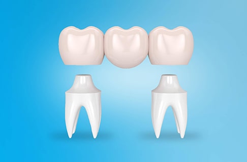 Was sind die Vor- und Nachteile einer Zahnbrücke?