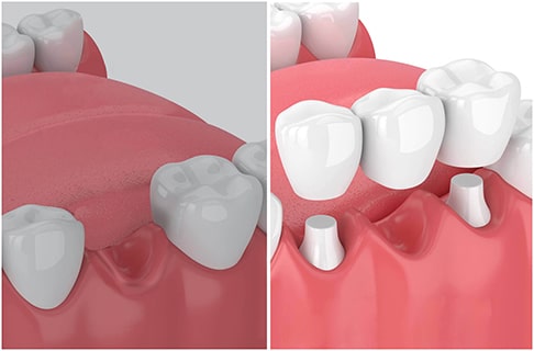 Wann und warum brauche ich eine Zahnbrücke?