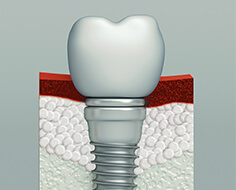 Was ist eine Zahnknochentransplantation und warum brauche ich sie?