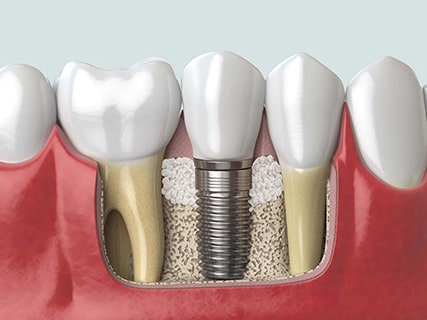 Ist eine Knochentransplantation sicher?
