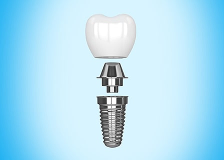 Was beinhalten die Kosten für ein Zahnimplantat?