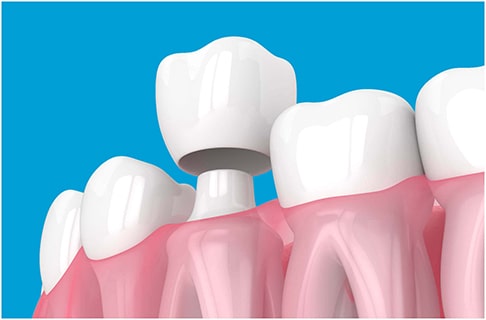 Was sind die Vor- und Nachteile einer Zahnkrone?